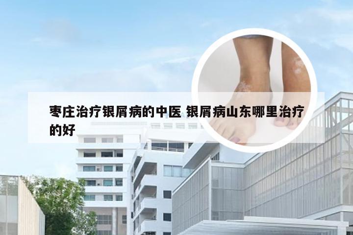 枣庄治疗银屑病的中医 银屑病山东哪里治疗的好