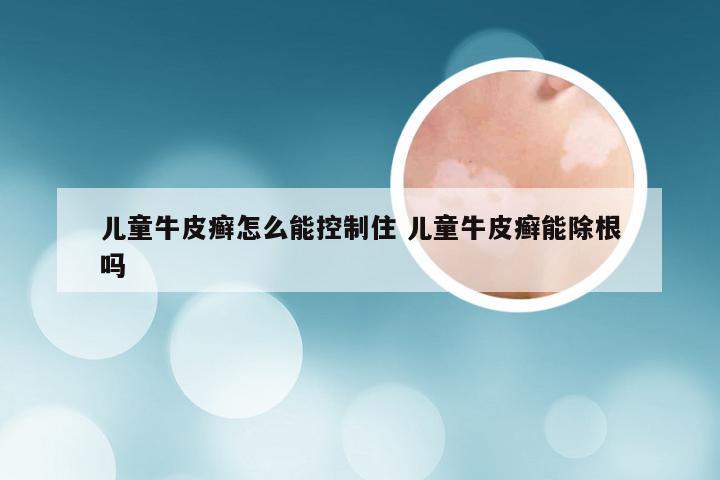 儿童牛皮癣怎么能控制住 儿童牛皮癣能除根吗