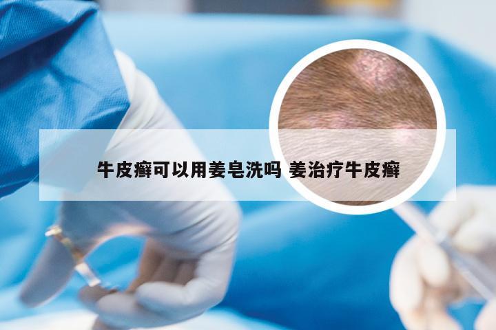 牛皮癣可以用姜皂洗吗 姜治疗牛皮癣