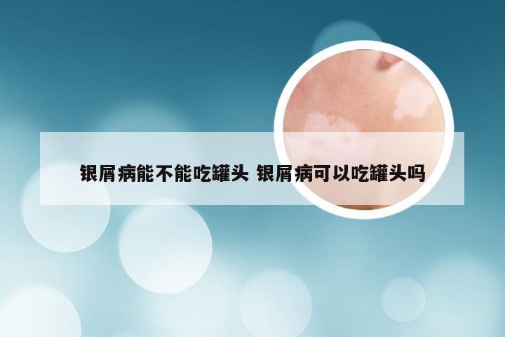 银屑病能不能吃罐头 银屑病可以吃罐头吗