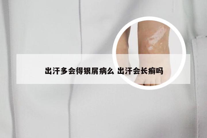 出汗多会得银屑病么 出汗会长癣吗