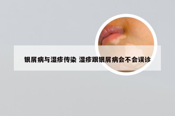 银屑病与湿疹传染 湿疹跟银屑病会不会误诊