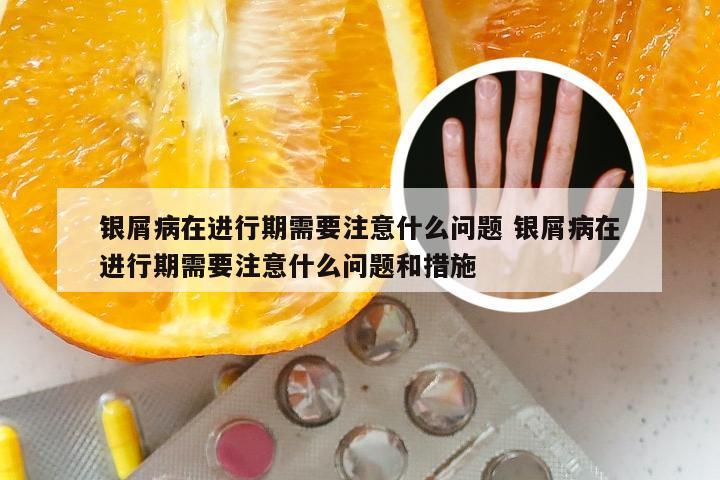 银屑病在进行期需要注意什么问题 银屑病在进行期需要注意什么问题和措施