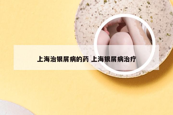 上海治银屑病的药 上海银屑病治疗