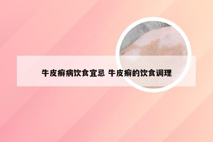 牛皮癣病饮食宜忌 牛皮癣的饮食调理