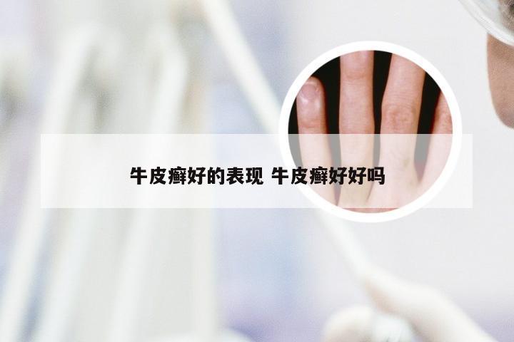 牛皮癣好的表现 牛皮癣好好吗