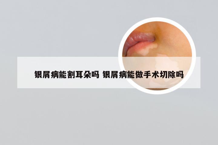 银屑病能割耳朵吗 银屑病能做手术切除吗