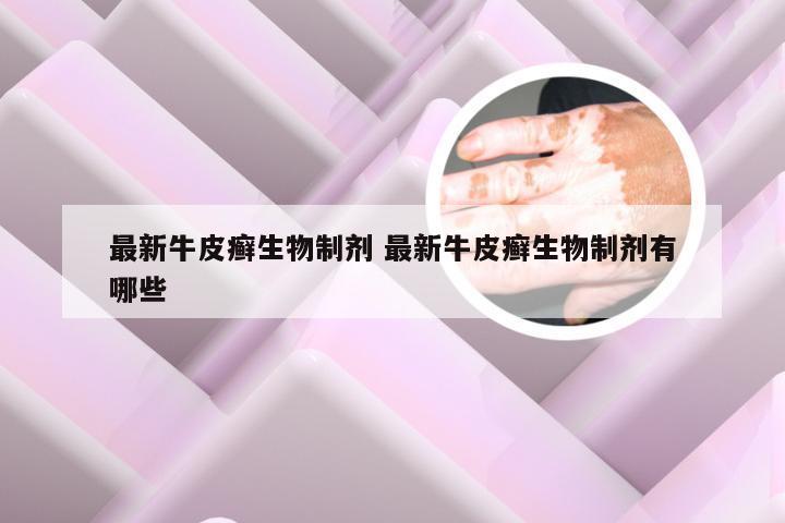 最新牛皮癣生物制剂 最新牛皮癣生物制剂有哪些