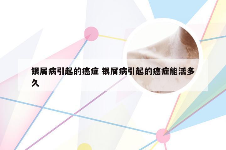 银屑病引起的癌症 银屑病引起的癌症能活多久