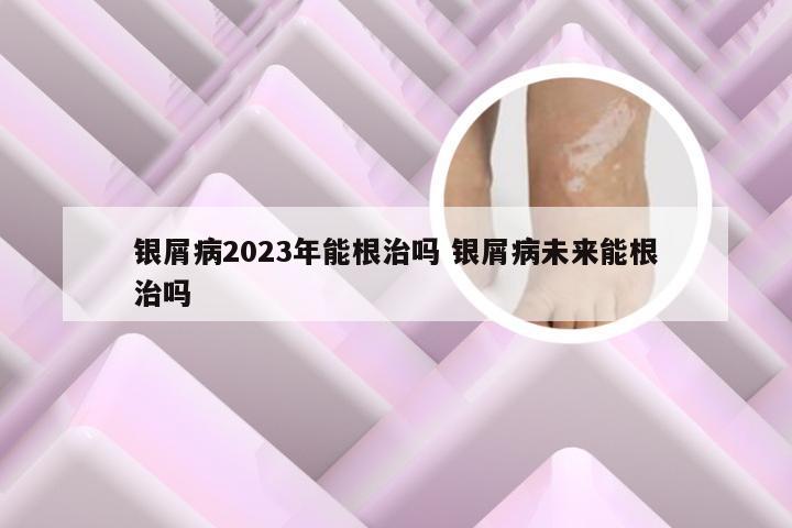 银屑病2023年能根治吗 银屑病未来能根治吗