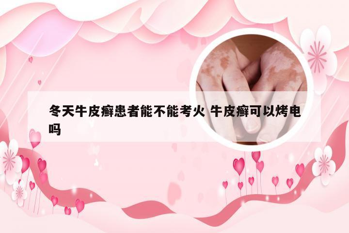 冬天牛皮癣患者能不能考火 牛皮癣可以烤电吗