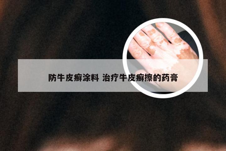 防牛皮癣涂料 治疗牛皮癣擦的药膏