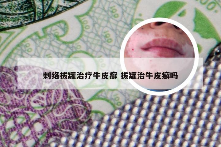 刺络拔罐治疗牛皮癣 拔罐治牛皮癣吗