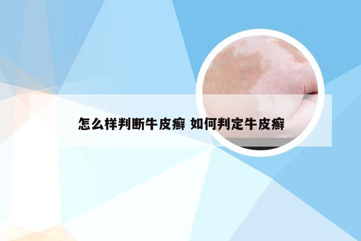 怎么样判断牛皮癣 如何判定牛皮癣