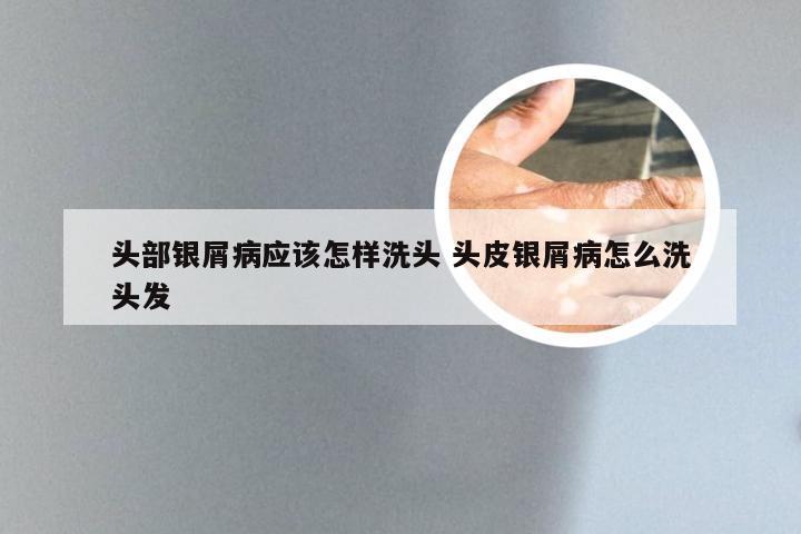 头部银屑病应该怎样洗头 头皮银屑病怎么洗头发
