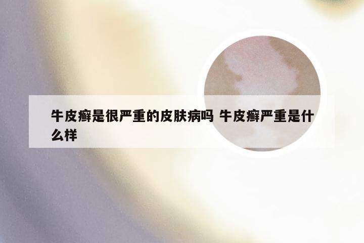 牛皮癣是很严重的皮肤病吗 牛皮癣严重是什么样