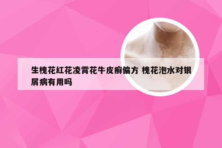 生槐花红花凌霄花牛皮癣偏方 槐花泡水对银屑病有用吗