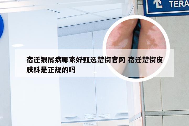 宿迁银屑病哪家好甄选楚街官网 宿迁楚街皮肤科是正规的吗