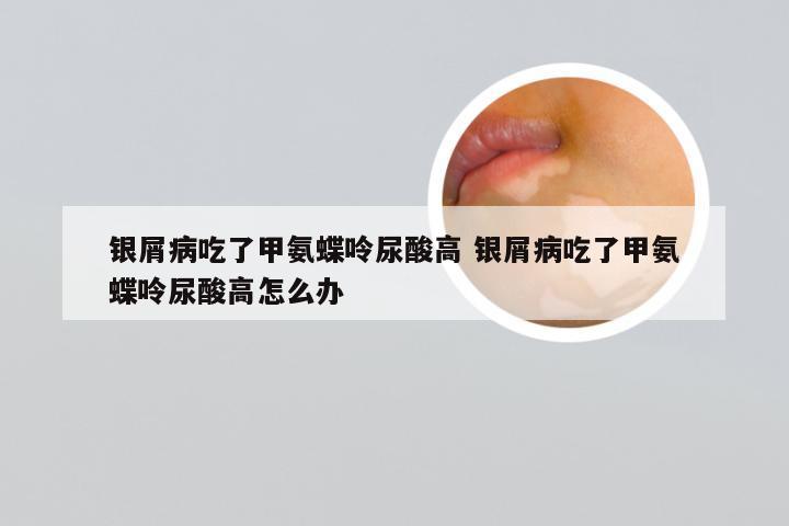 银屑病吃了甲氨蝶呤尿酸高 银屑病吃了甲氨蝶呤尿酸高怎么办