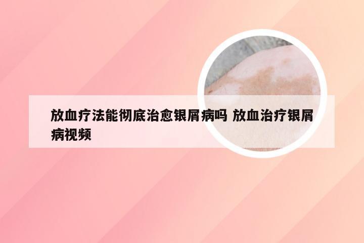 放血疗法能彻底治愈银屑病吗 放血治疗银屑病视频