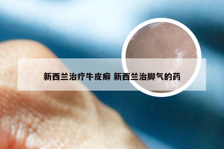 新西兰治疗牛皮癣 新西兰治脚气的药