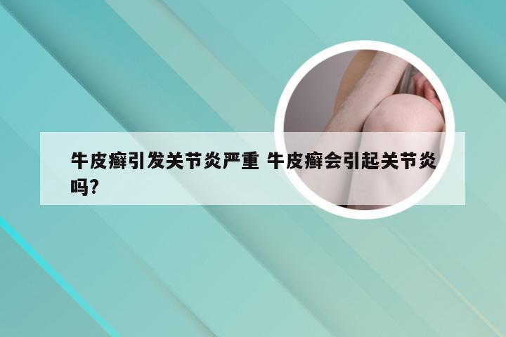 牛皮癣引发关节炎严重 牛皮癣会引起关节炎吗?