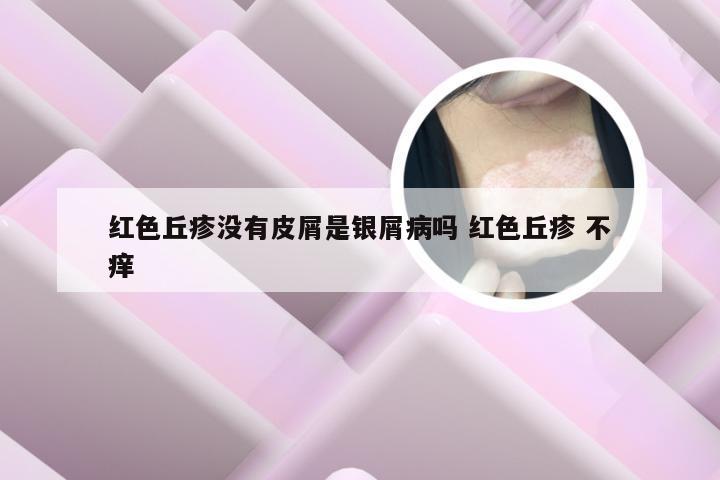 红色丘疹没有皮屑是银屑病吗 红色丘疹 不痒