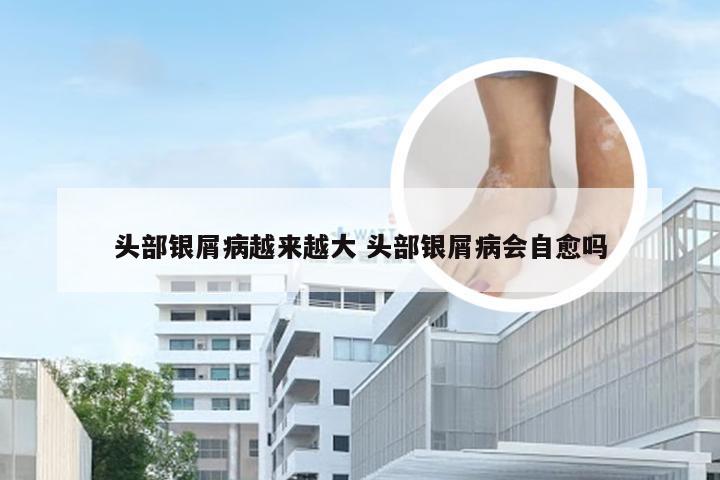 头部银屑病越来越大 头部银屑病会自愈吗