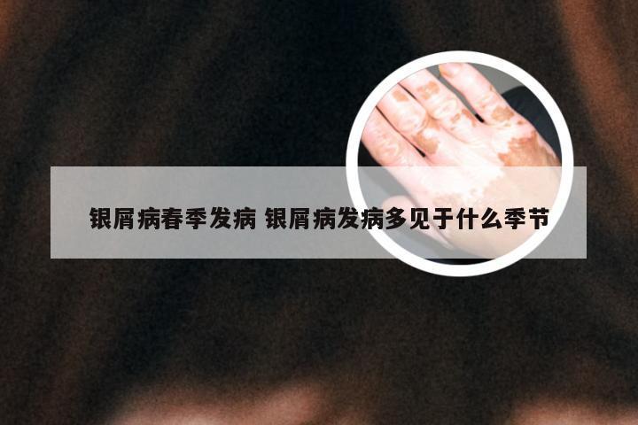 银屑病春季发病 银屑病发病多见于什么季节