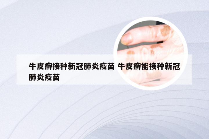 牛皮癣接种新冠肺炎疫苗 牛皮癣能接种新冠肺炎疫苗