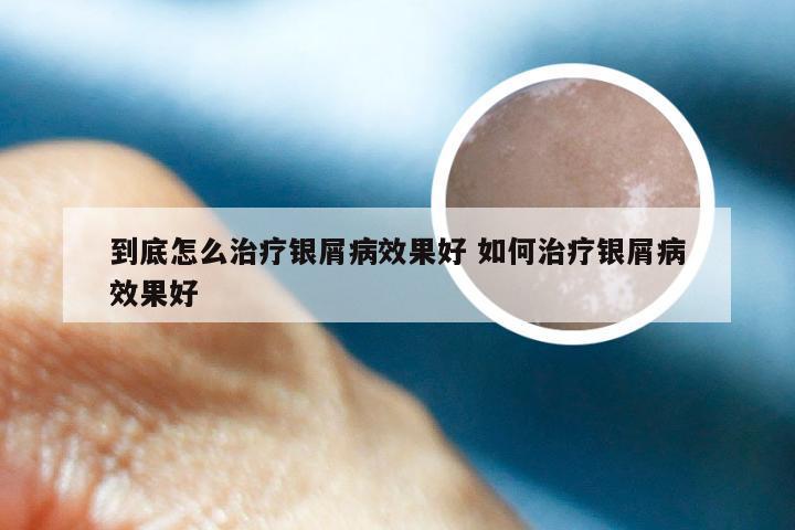 到底怎么治疗银屑病效果好 如何治疗银屑病效果好