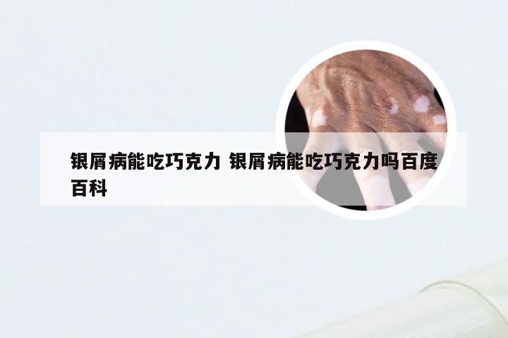 银屑病能吃巧克力 银屑病能吃巧克力吗百度百科