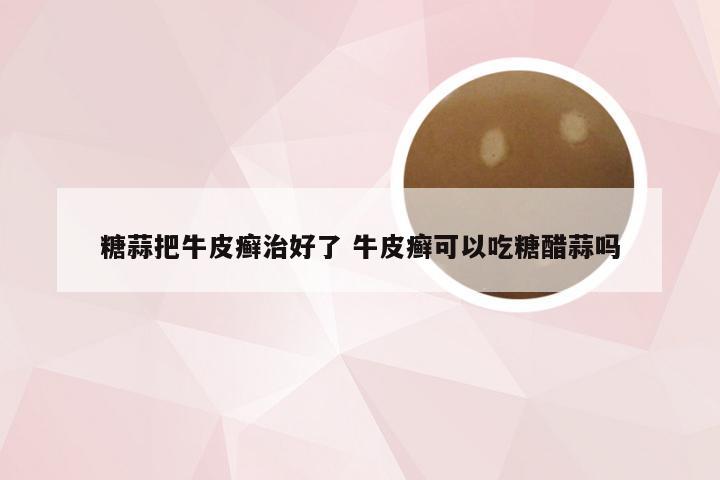 糖蒜把牛皮癣治好了 牛皮癣可以吃糖醋蒜吗