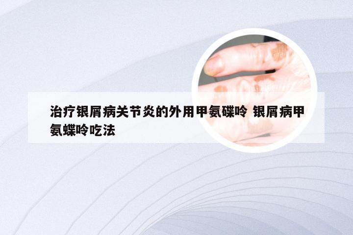 治疗银屑病关节炎的外用甲氨碟呤 银屑病甲氨蝶呤吃法