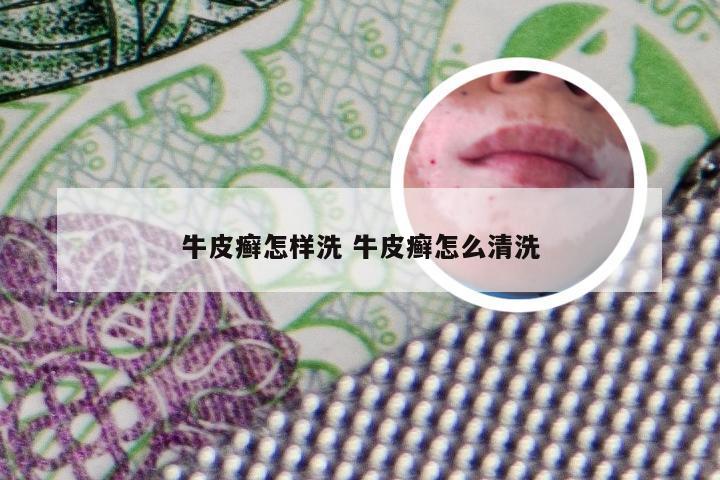 牛皮癣怎样洗 牛皮癣怎么清洗