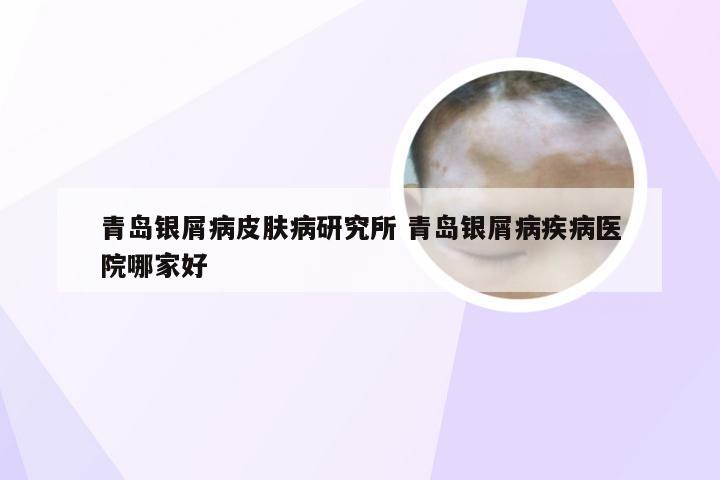 青岛银屑病皮肤病研究所 青岛银屑病疾病医院哪家好