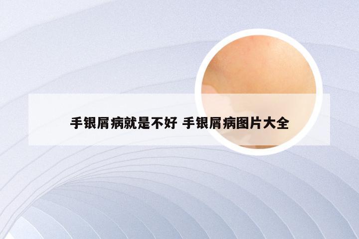 手银屑病就是不好 手银屑病图片大全