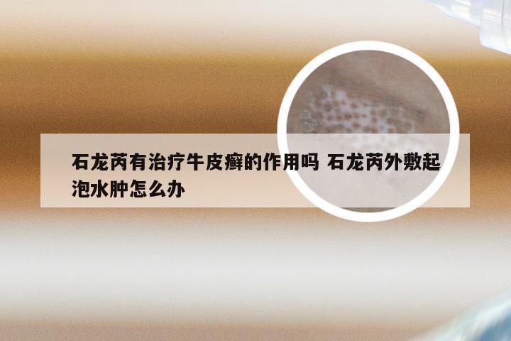 石龙芮有治疗牛皮癣的作用吗 石龙芮外敷起泡水肿怎么办