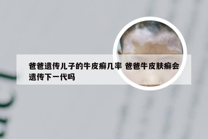 爸爸遗传儿子的牛皮癣几率 爸爸牛皮肤癣会遗传下一代吗