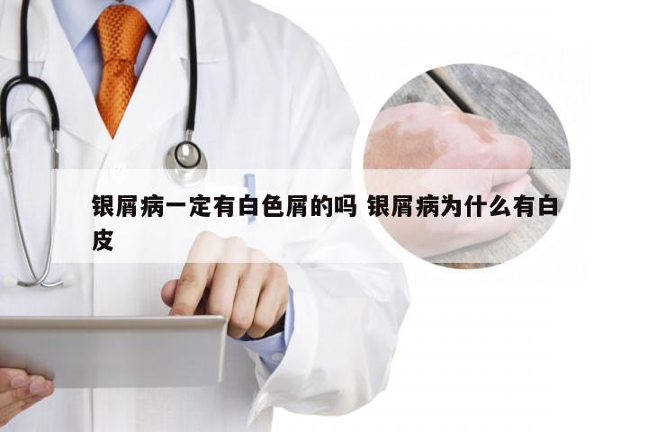 银屑病一定有白色屑的吗 银屑病为什么有白皮