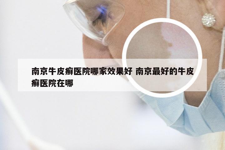 南京牛皮癣医院哪家效果好 南京最好的牛皮癣医院在哪