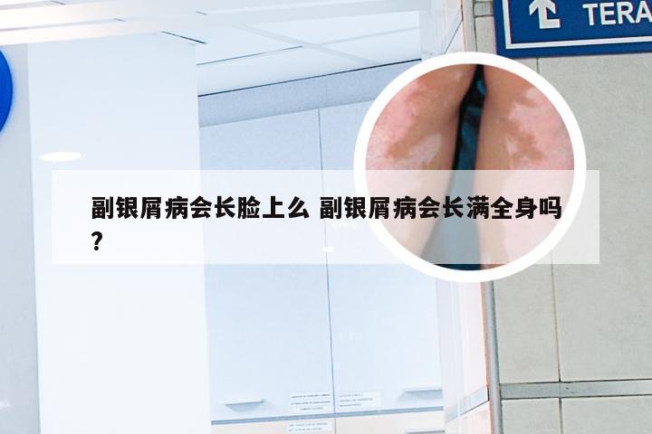 副银屑病会长脸上么 副银屑病会长满全身吗?