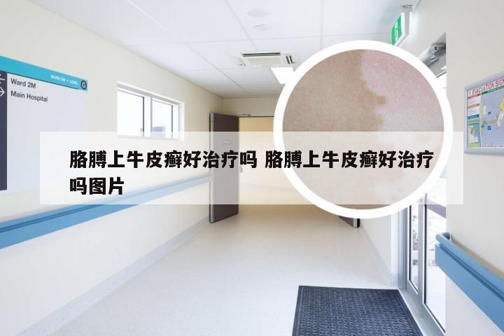 胳膊上牛皮癣好治疗吗 胳膊上牛皮癣好治疗吗图片