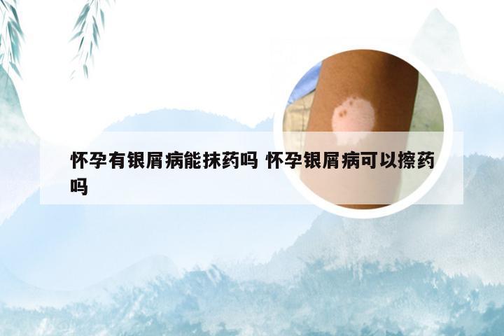 怀孕有银屑病能抹药吗 怀孕银屑病可以擦药吗
