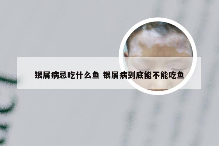 银屑病忌吃什么鱼 银屑病到底能不能吃鱼