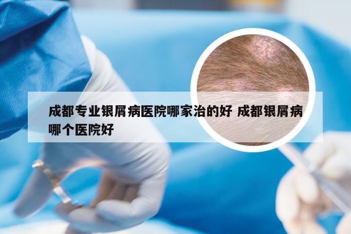 成都专业银屑病医院哪家治的好 成都银屑病哪个医院好