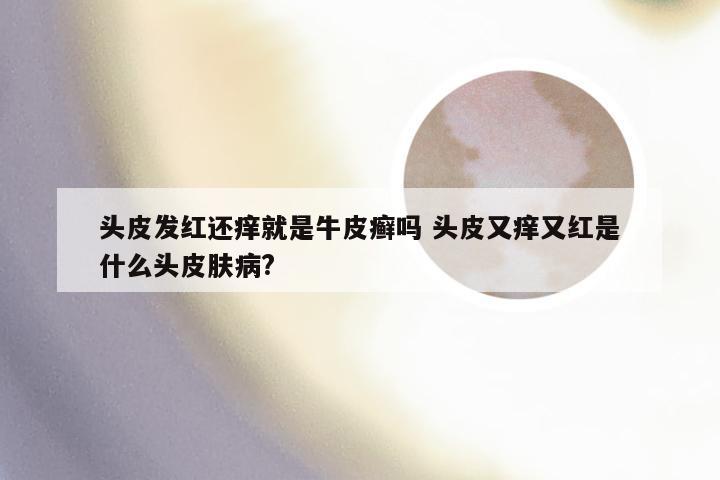 头皮发红还痒就是牛皮癣吗 头皮又痒又红是什么头皮肤病?