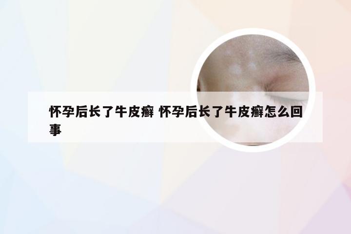 怀孕后长了牛皮癣 怀孕后长了牛皮癣怎么回事