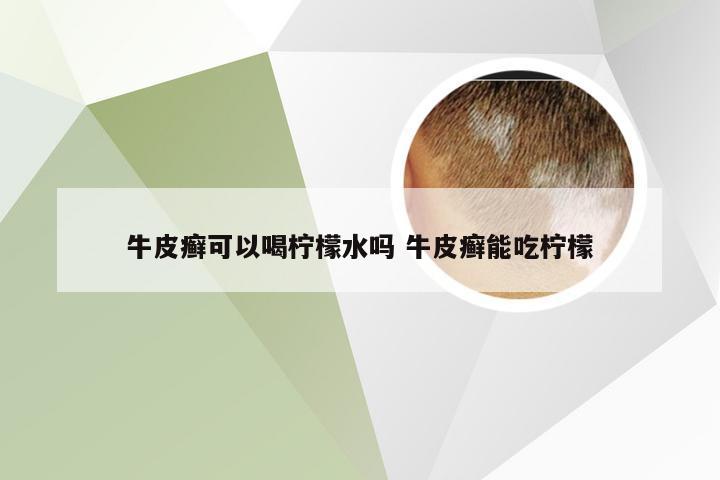 牛皮癣可以喝柠檬水吗 牛皮癣能吃柠檬