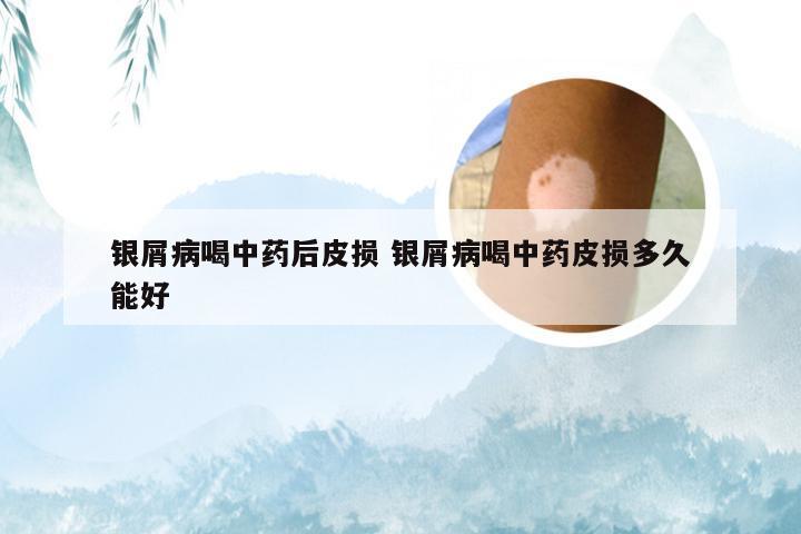 银屑病喝中药后皮损 银屑病喝中药皮损多久能好